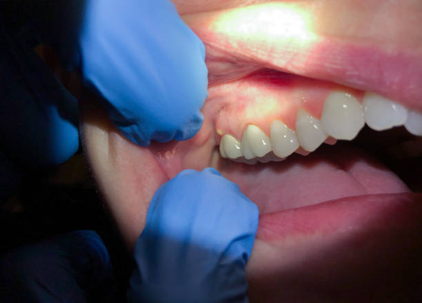 Best Emergency Treatment for Dental Infections or Abscesses in Fosston, MN